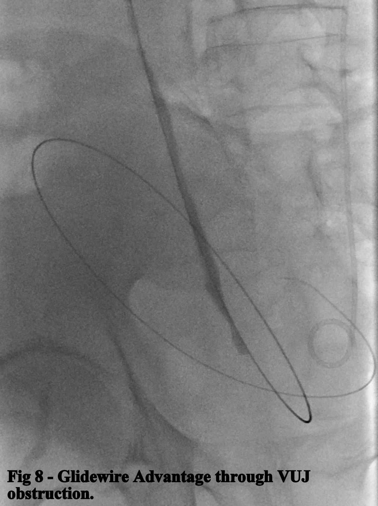 Fig 8. Glidewire Advantage through VUJ obstruction